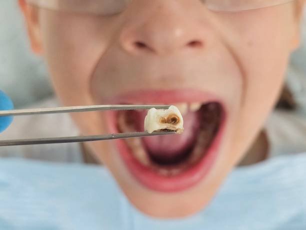 Best Emergency Wisdom Teeth Removal in Air Force Academy, CO